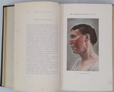 CHATELAIN Élie (Dr.) "Précis iconographique des maladies de la peau. Avec 50 planches en couleurs, reproduites d'après nature par Félix Méheux"